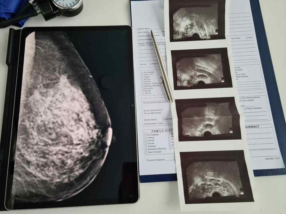 Présentation d'une photo d'une radiographie d'un sein pour dépistage du ganglion sentinelle tumeur