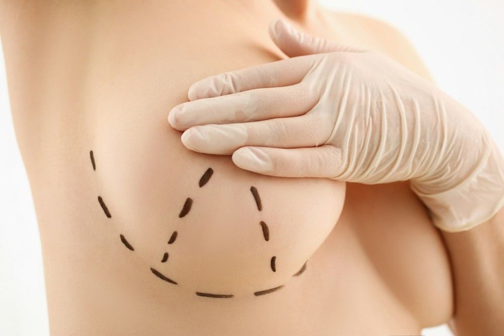 Présentation d'un corps d'une femme allant se faire tatouer le téton pour reconstruction mammaire