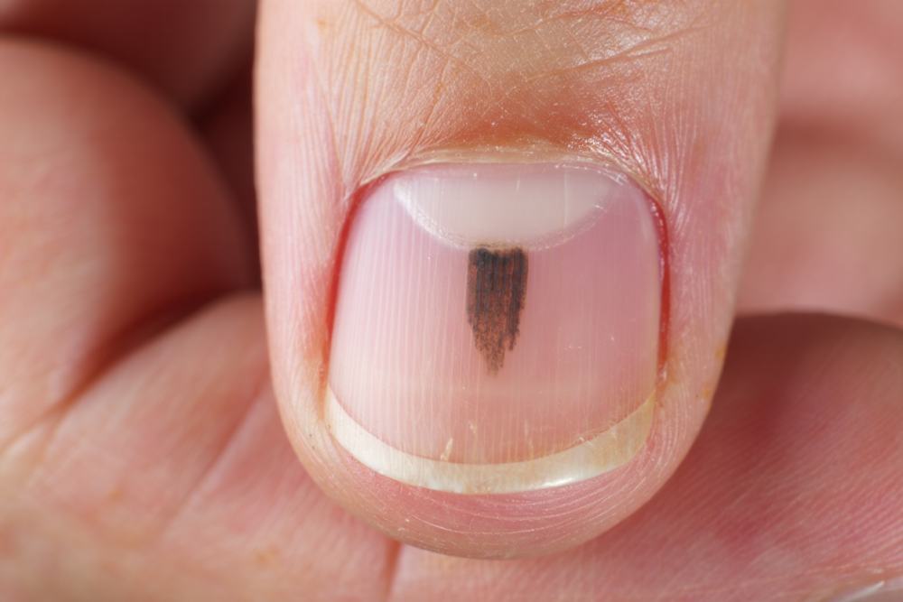 Mélanome débutant de l’ongle : Photos et traitements