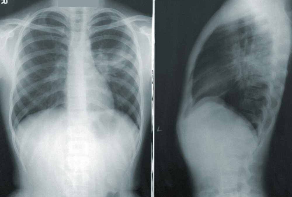Radiographie des poumons face profil peut-on vivre 10 ans avec un cancer du poumon