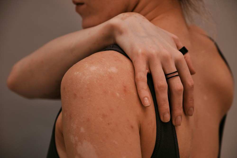 Femme ayant tache blanche sur la peau