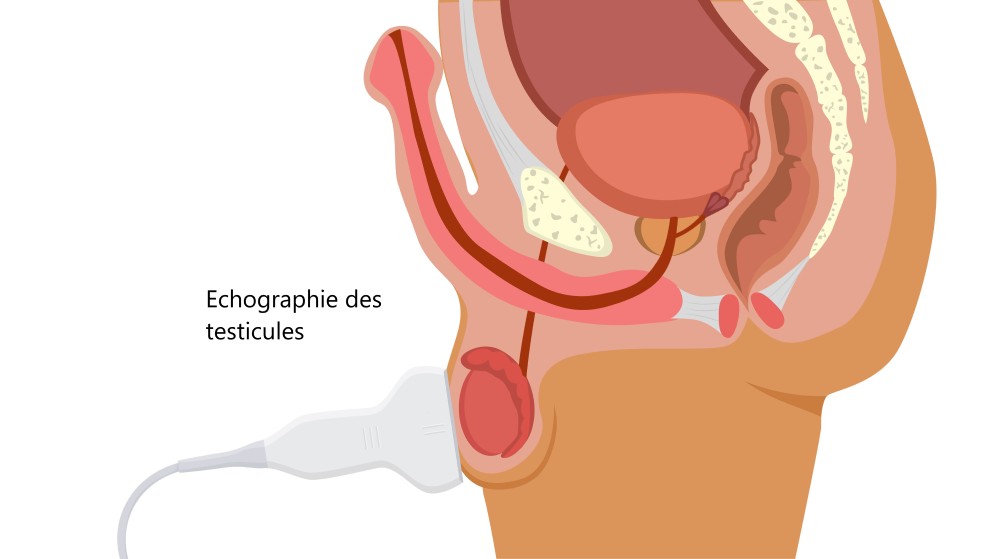 cancer-des-testicules-photo-echographie-scrotum Cancer des testicules photo-échographie scrotum