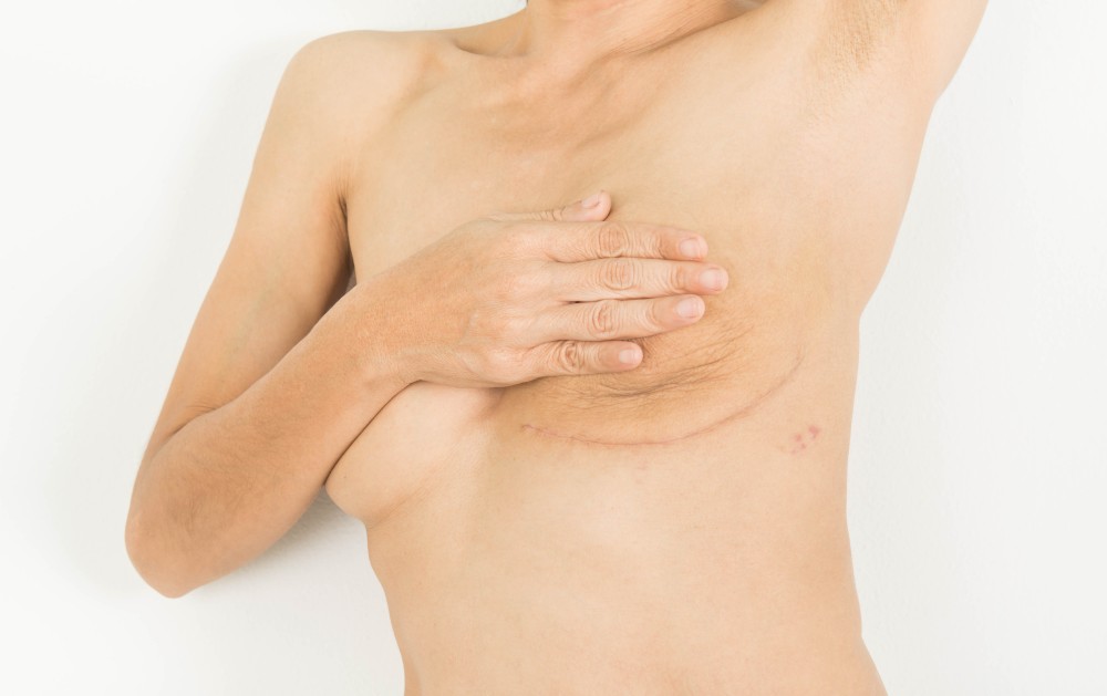 Femme ayant subi une mastectomie gauche cancer du sein