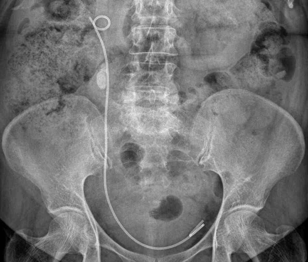 Sonde JJ, sonde double J