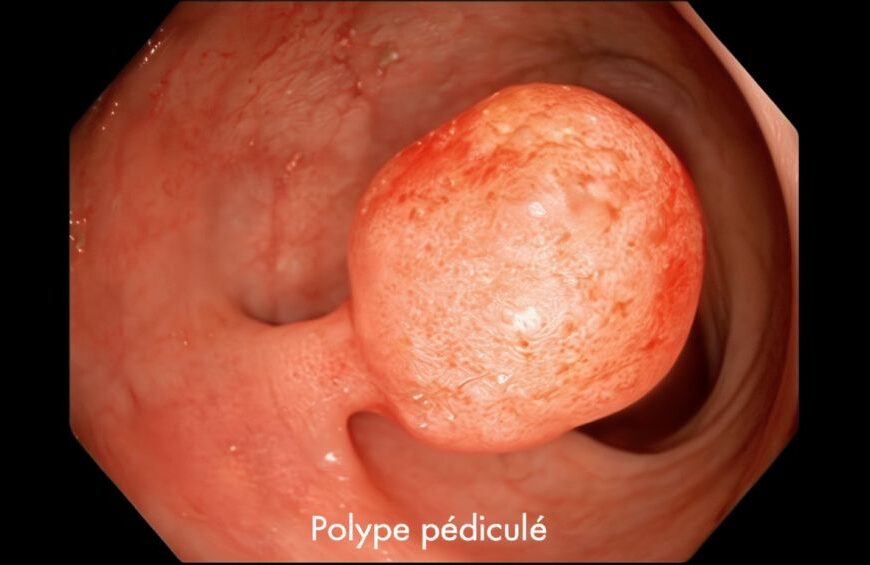 Combien de temps met un polype pour devenir cancéreux