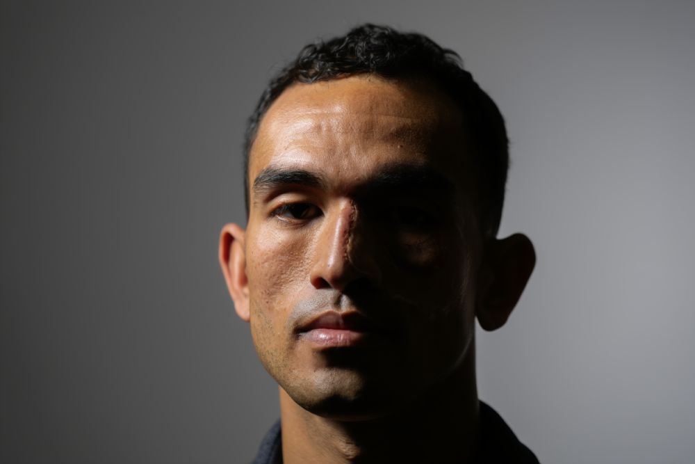 Cancer du nez photos