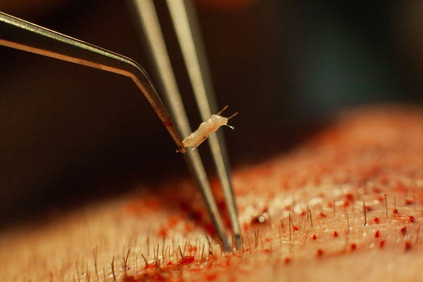 Chirurgie greffe implants capillaires