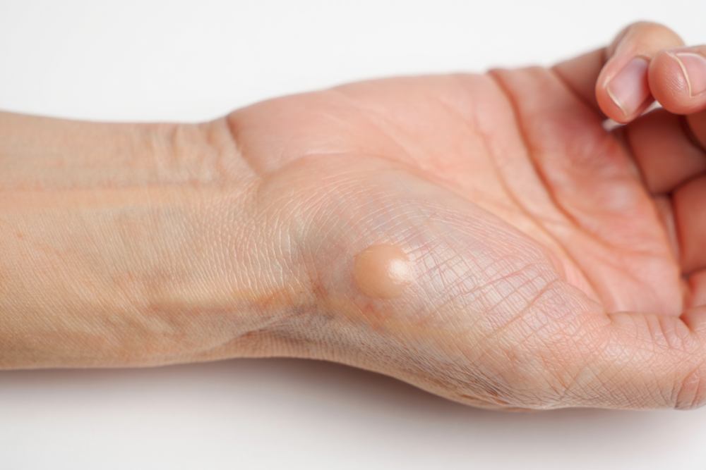 Est-ce que des nodules c&rsquo;est un cancer ?