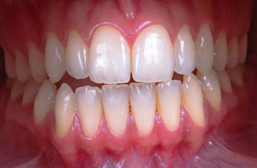 Céramique dentaire capdentaire, dentition propre et saine