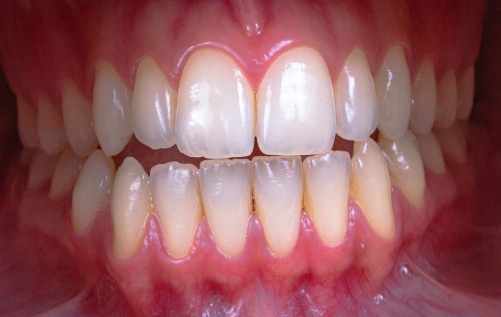 Céramique dentaire capdentaire, dentition propre et saine