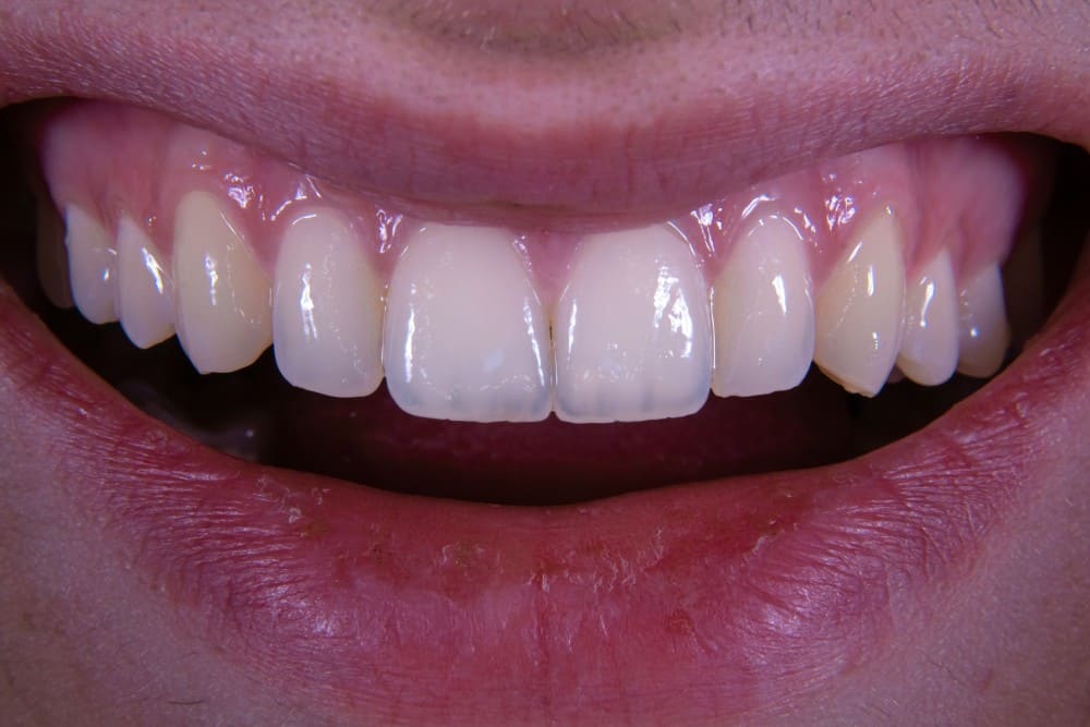 Couronne céramique faite par une imprimante 3D capdentaire