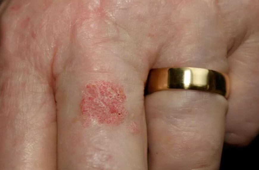 Photo maladie de Bowen