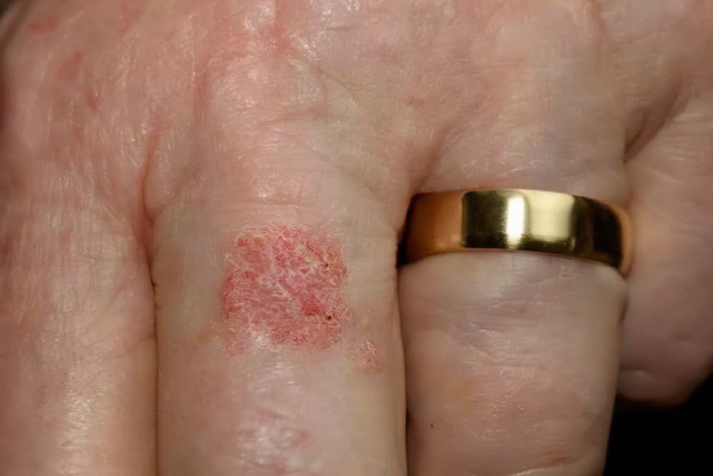 Photo maladie de Bowen