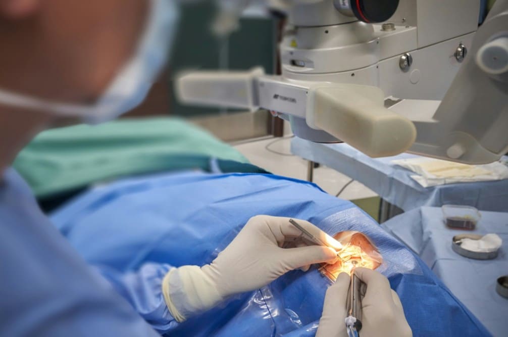 Chirurgie réfractive cataracte