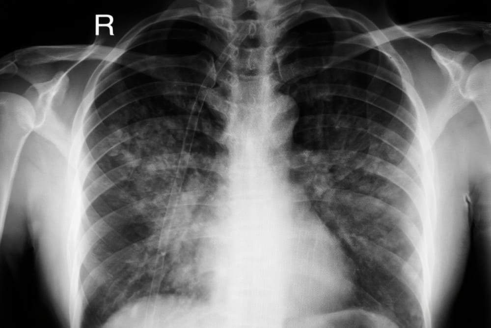 Œdème pulmonaire espérance de vie