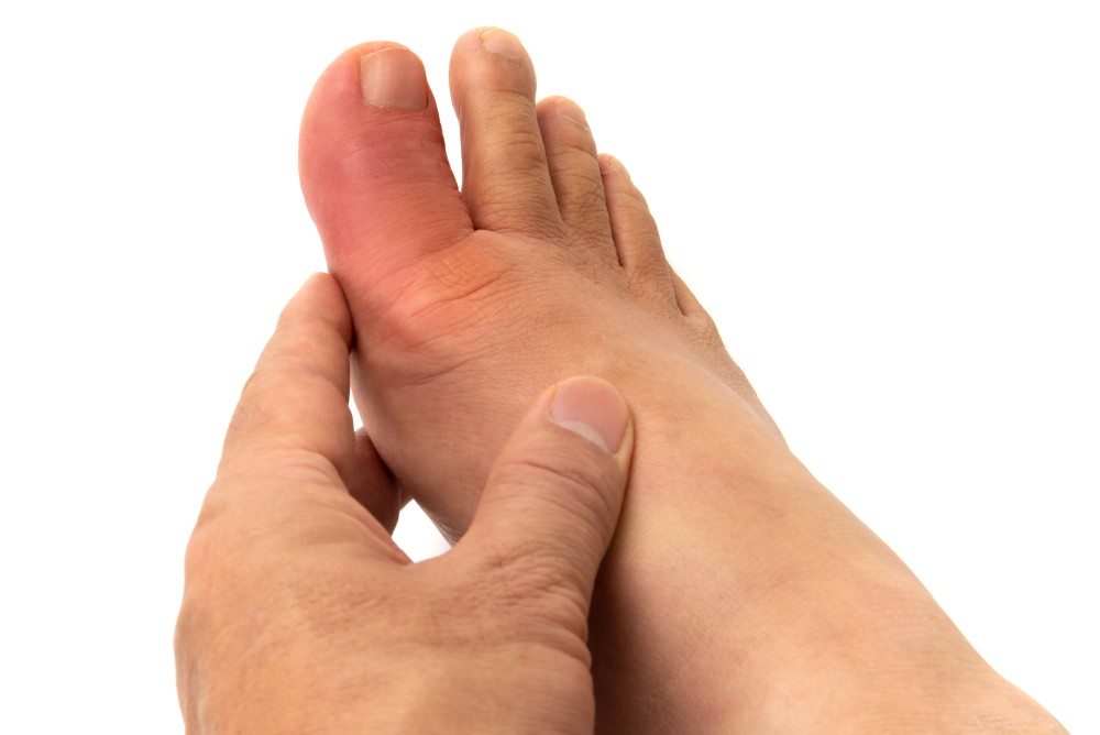 Douleur pied goutte taux urée élevé