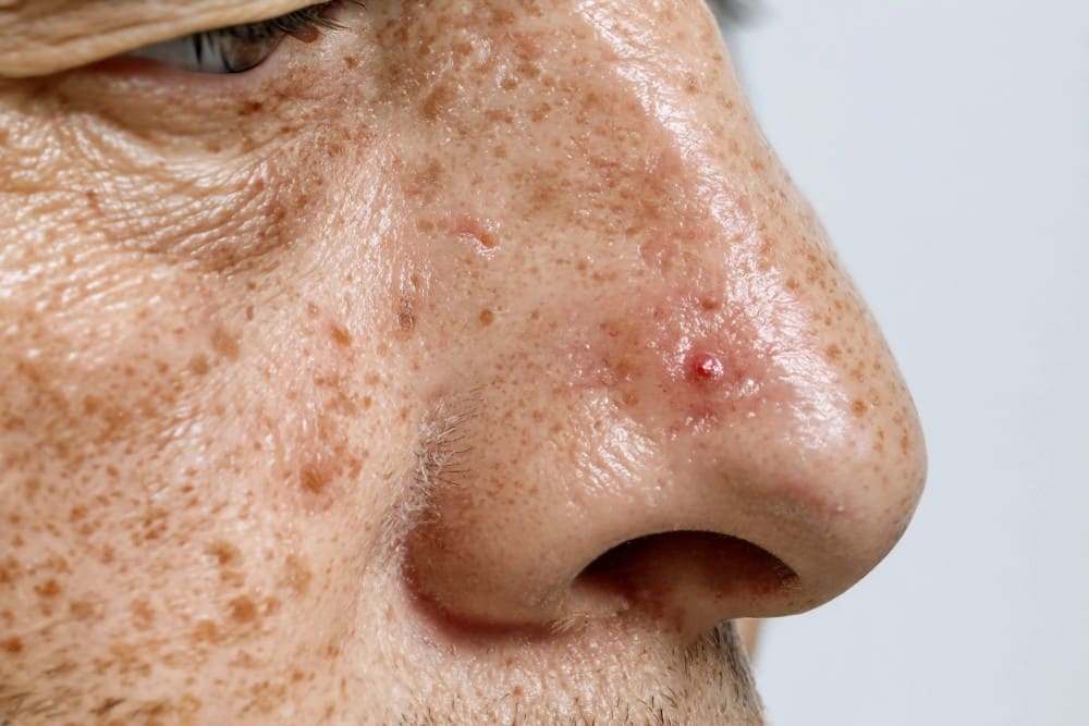 Carcinome du nez