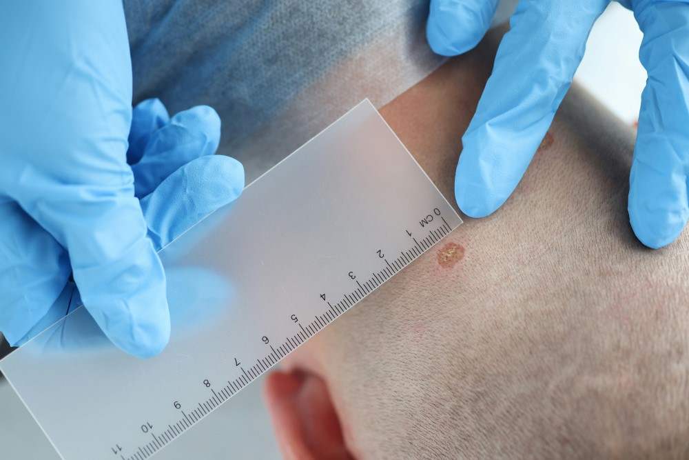 Photo carcinome basocellulaire