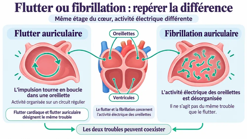 Flutter ou fibrillation : repérer la différence. Même étage du cœur, activité électrique différente